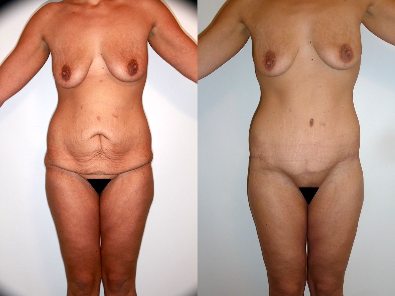Avant et après une plastie abdominale, exemple 1