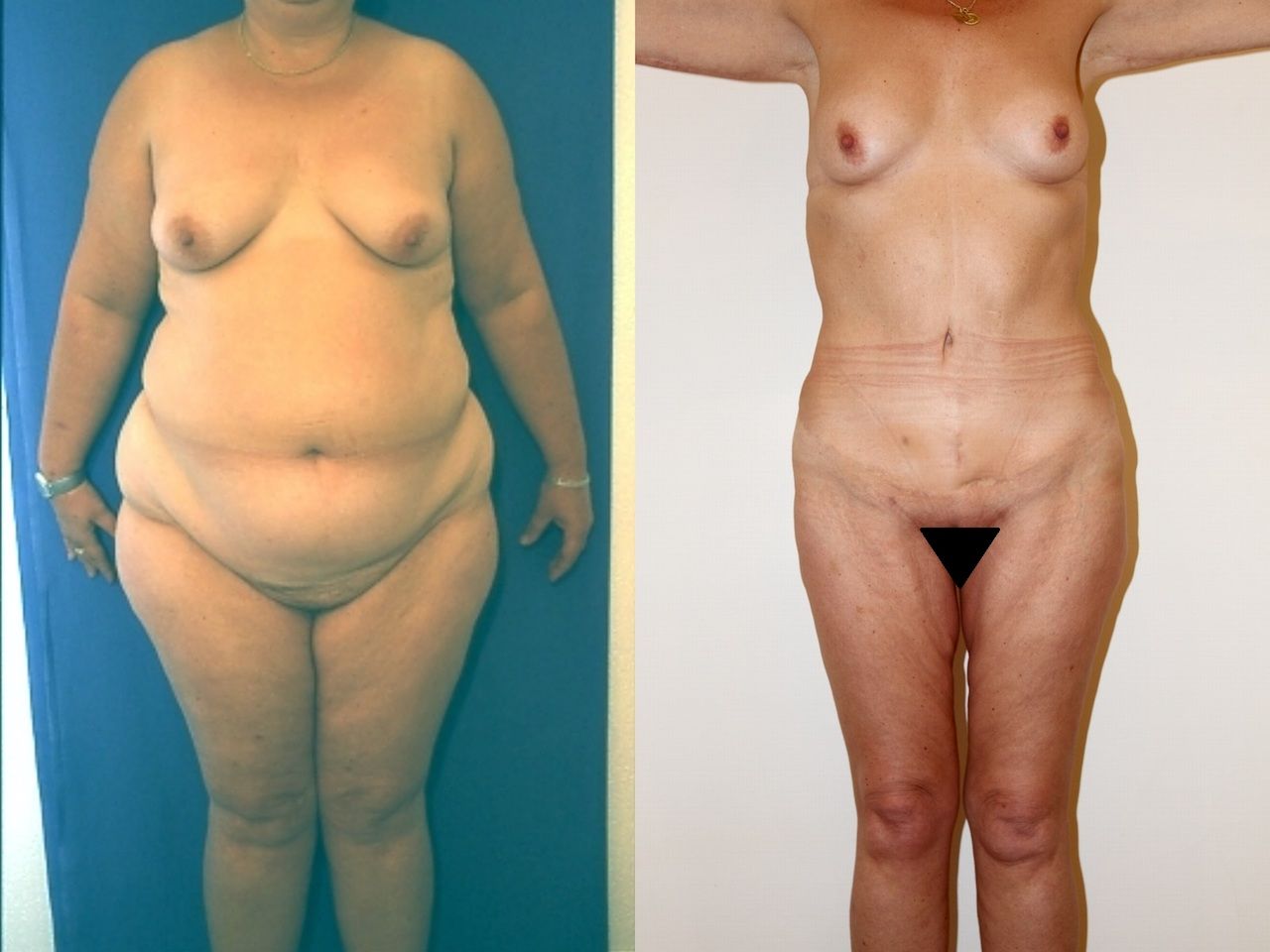 Avant et après une plastie abdominale, exemple 2