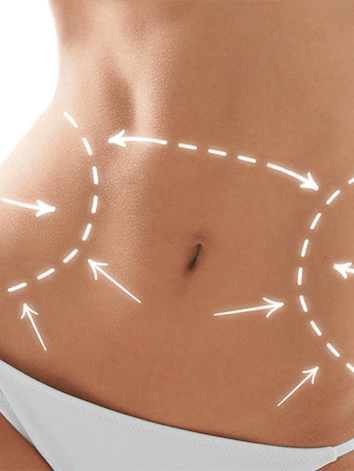 Consultation pour une abdominoplastie